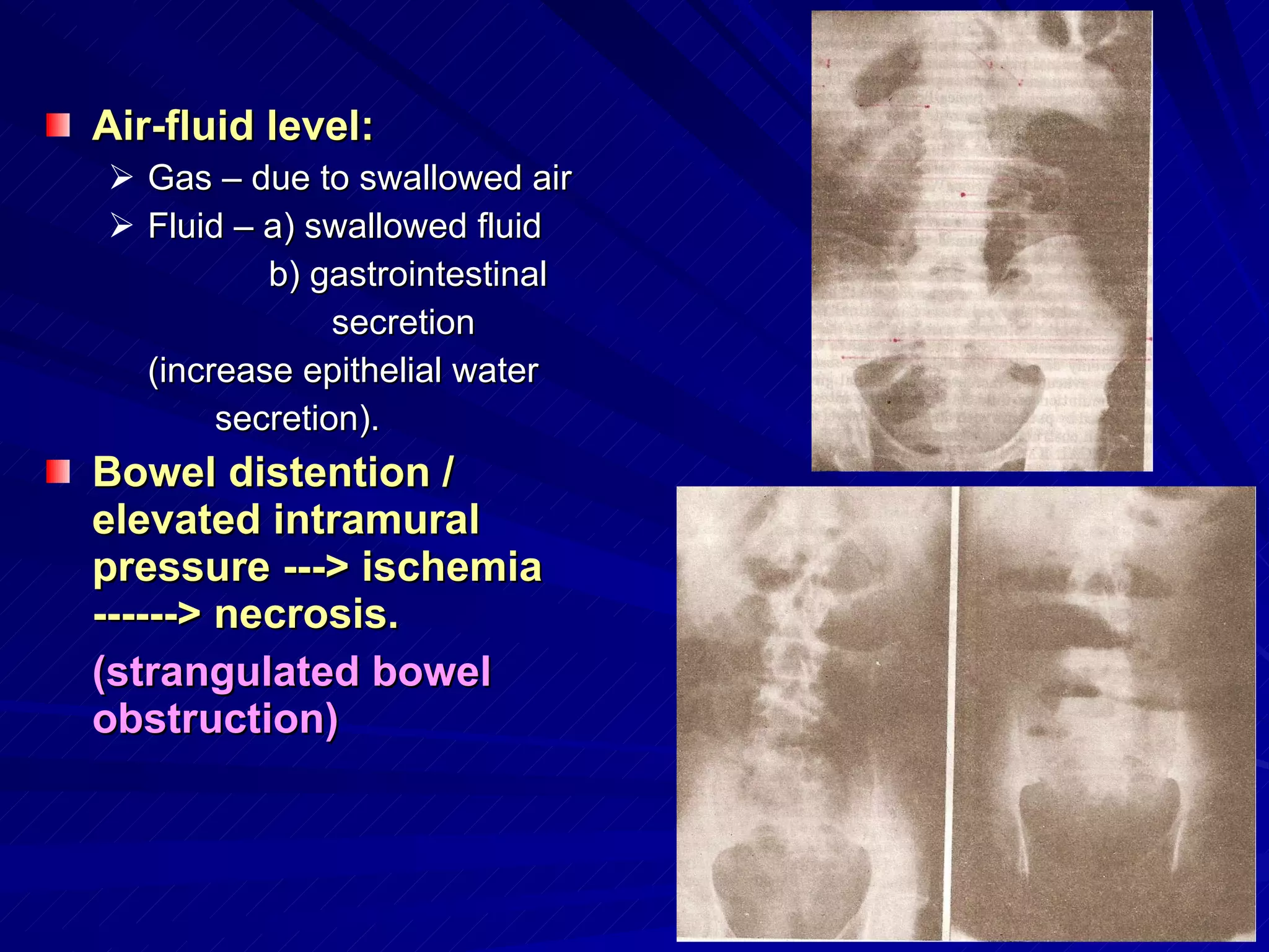 Air-fluid level: Gas – due to swallowed air Fluid – a) swallowed fluid   b) gastrointestinal  secretion  (increase epithelial water  secretion). Bowel distention / elevated intramural pressure ---> ischemia ------> necrosis. (strangulated bowel obstruction) 