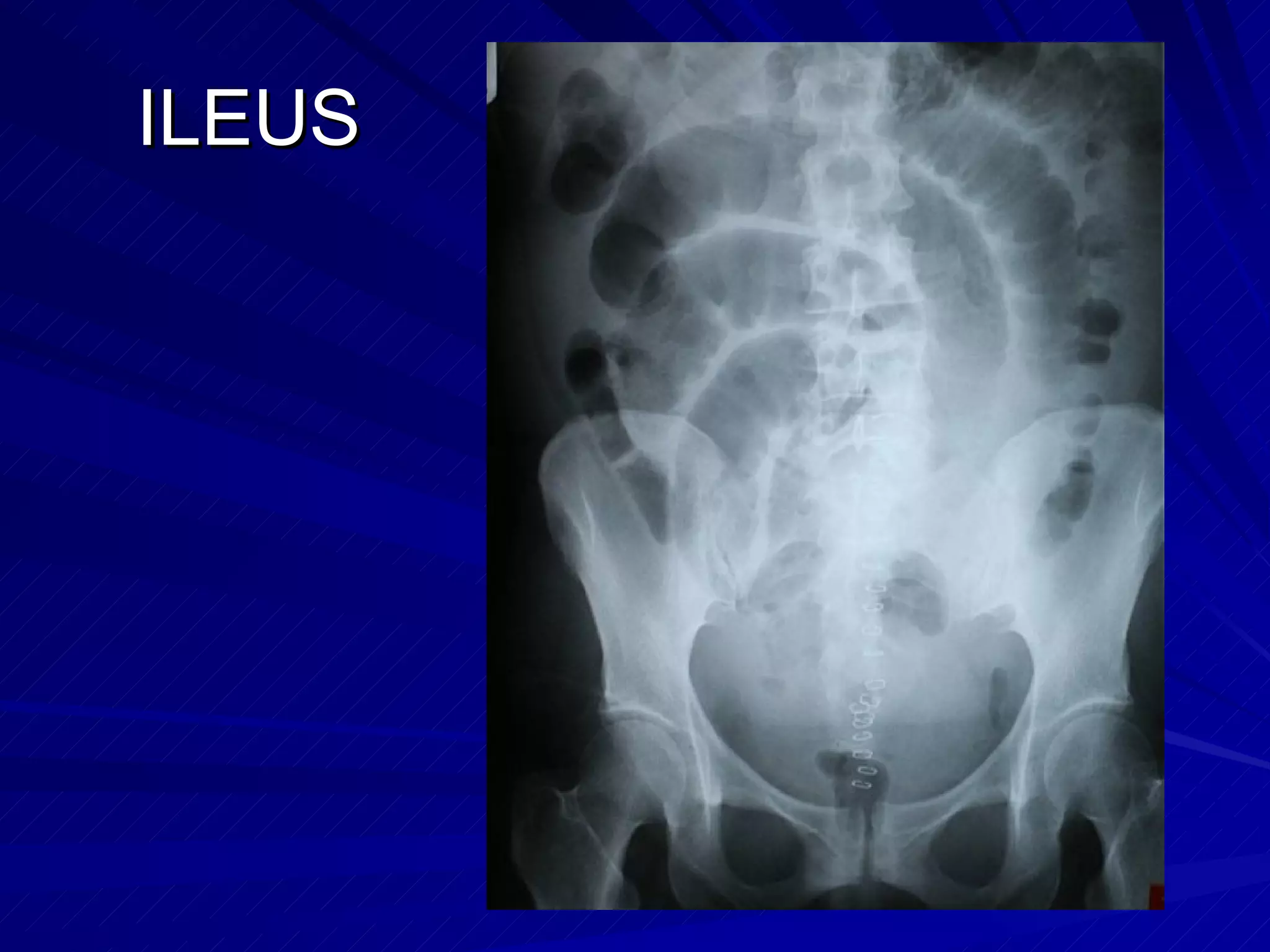 ILEUS 