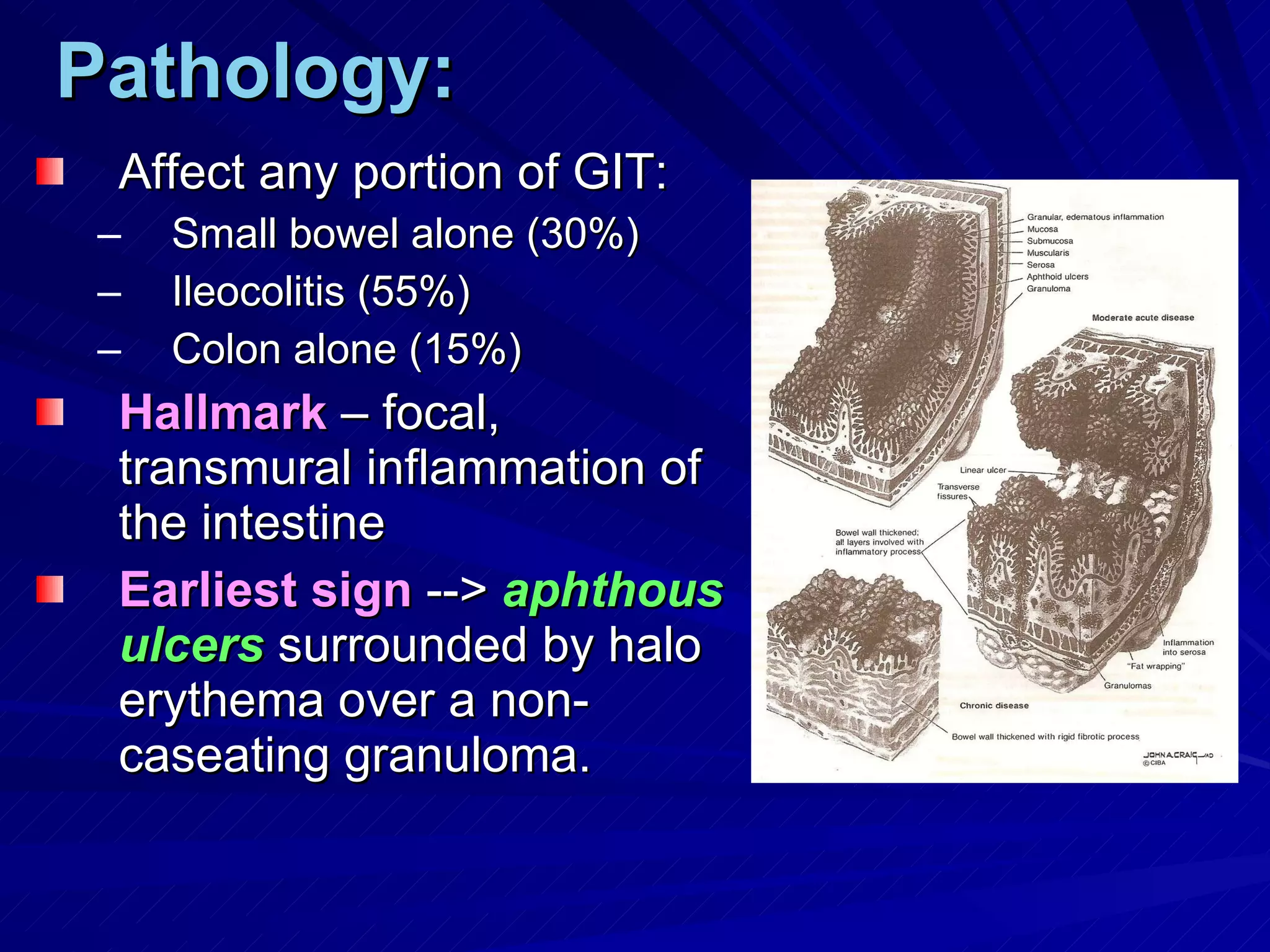 Pathology: Affect any portion of GIT: Small bowel alone (30%) Ileocolitis (55%) Colon alone (15%) Hallmark  – focal, transmural inflammation of the intestine Earliest sign  -->  aphthous ulcers  surrounded by halo erythema over a non-caseating granuloma. 