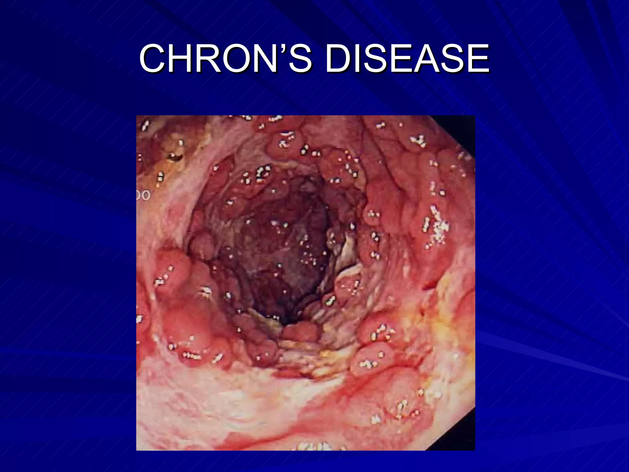 CHRON’S DISEASE 