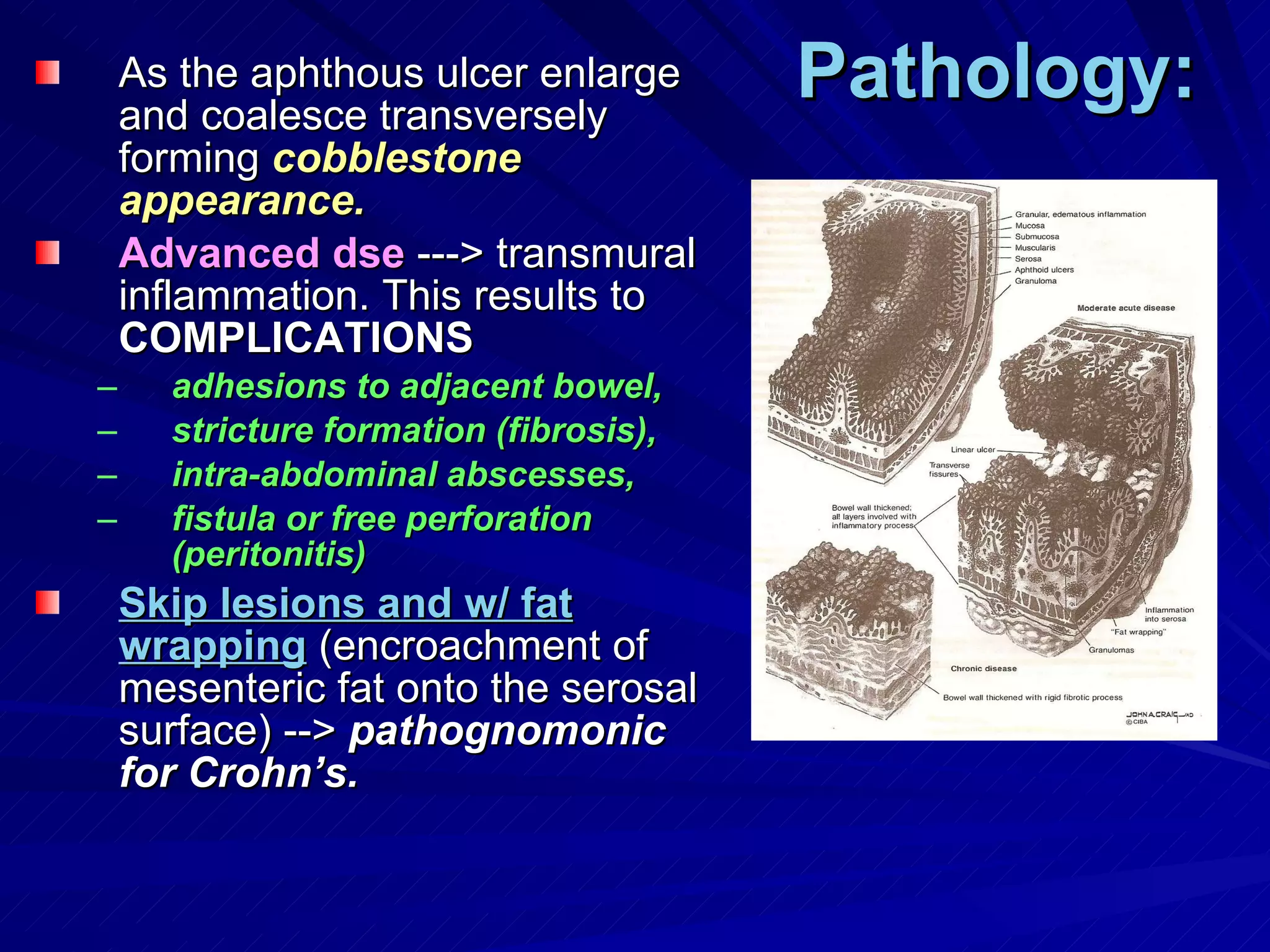 Pathology: As the aphthous ulcer enlarge and coalesce transversely forming  cobblestone appearance. Advanced dse  ---> transmural inflammation. This results to  COMPLICATIONS adhesions to adjacent bowel, stricture formation (fibrosis),  intra-abdominal abscesses,  fistula or free perforation (peritonitis) Skip lesions and w/ fat   wrapping  (encroachment of mesenteric fat onto the serosal surface) -->  pathognomonic for Crohn’s. 