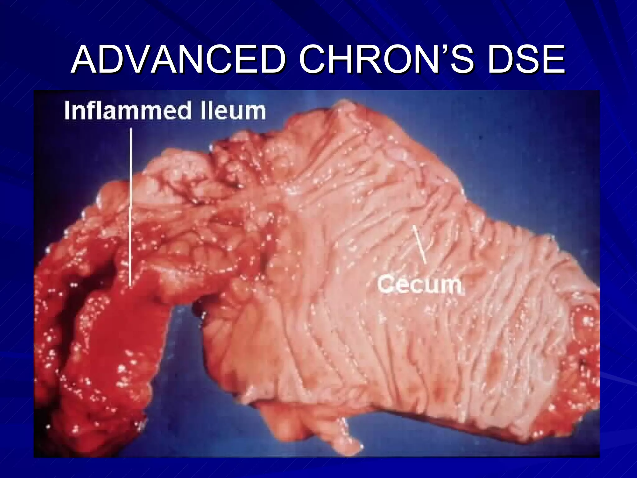 ADVANCED CHRON’S DSE 