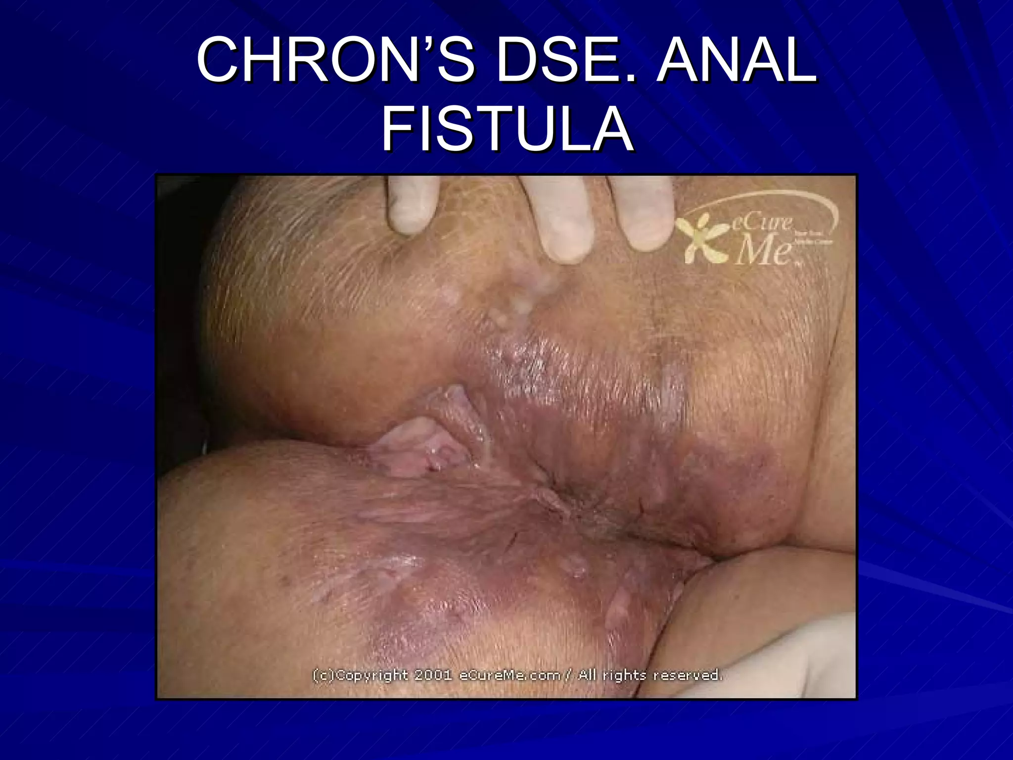 CHRON’S DSE. ANAL FISTULA 
