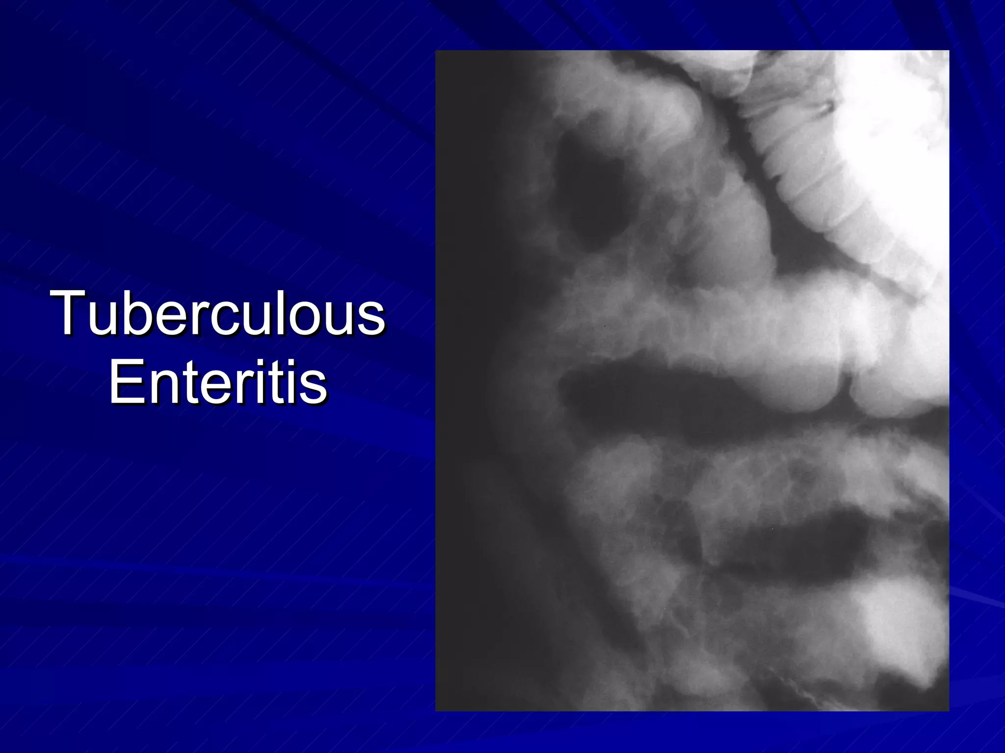 Tuberculous Enteritis 