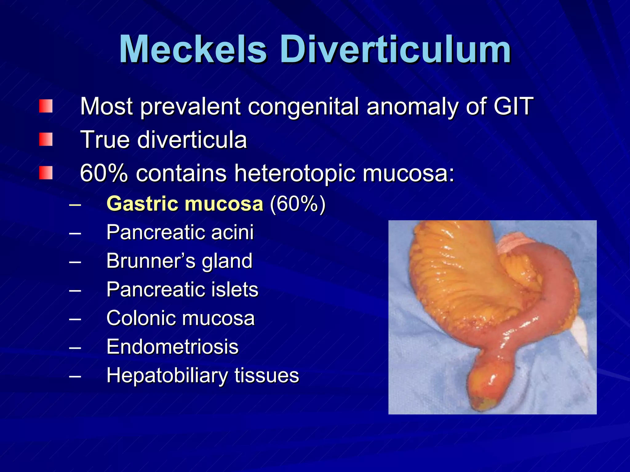 Meckels Diverticulum Most prevalent congenital anomaly of GIT True diverticula 60% contains heterotopic mucosa: Gastric mucosa  (60%) Pancreatic acini Brunner’s gland Pancreatic islets Colonic mucosa Endometriosis Hepatobiliary tissues 