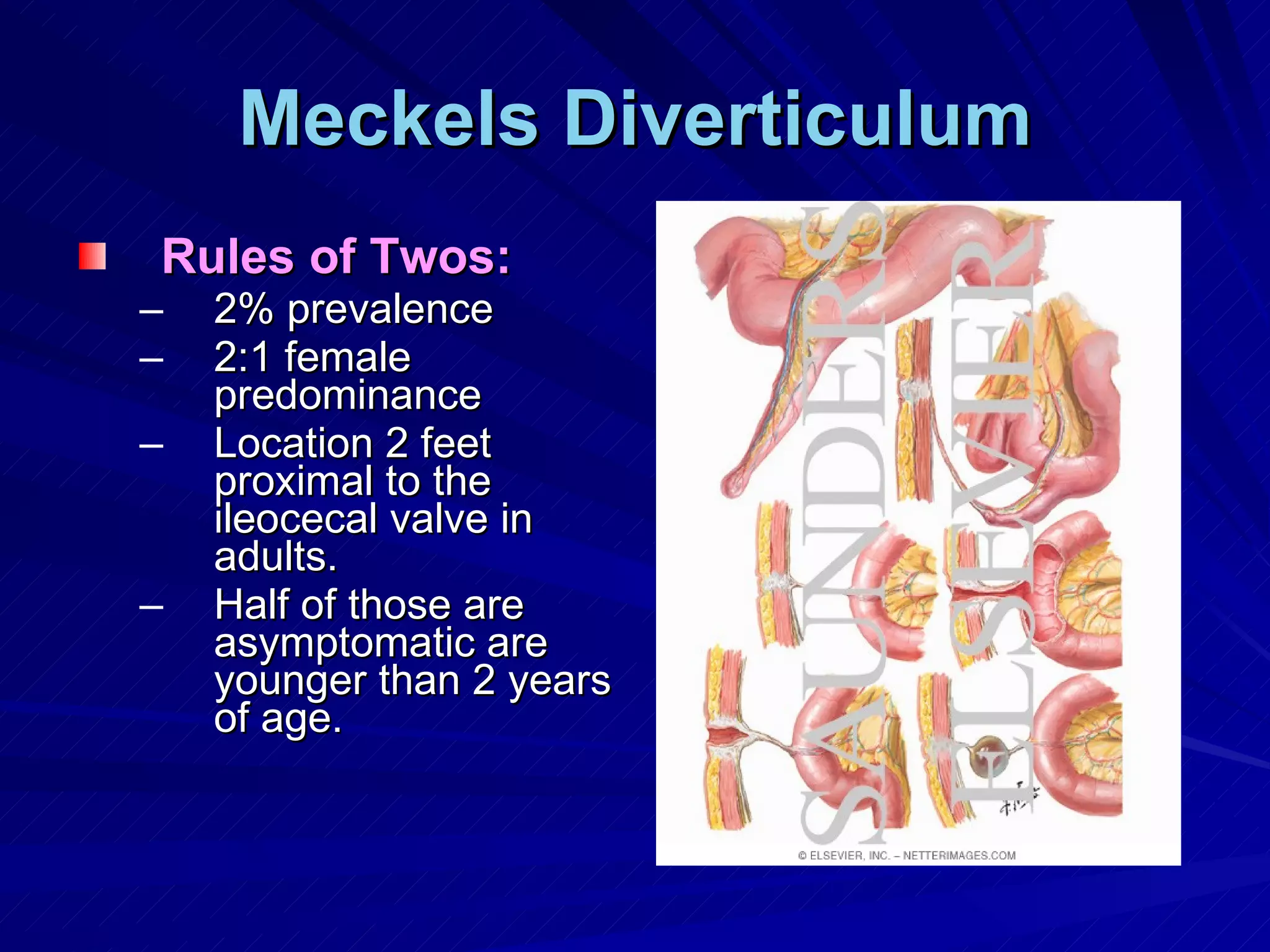 Meckels Diverticulum Rules of Twos: 2% prevalence 2:1 female predominance Location 2 feet proximal to the ileocecal valve in adults. Half of those are asymptomatic are younger than 2 years of age. 