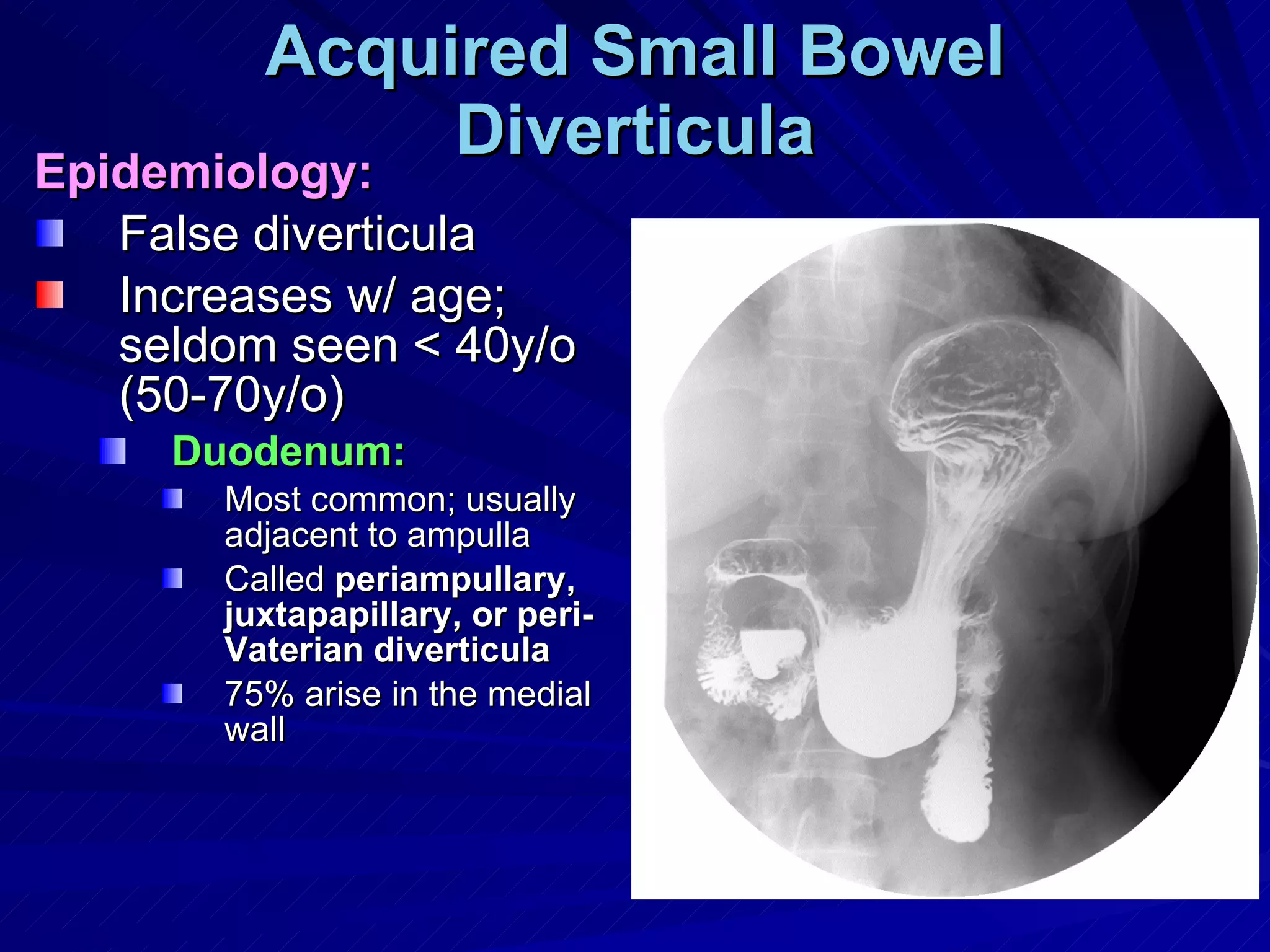 Acquired Small Bowel Diverticula Epidemiology: False diverticula Increases w/ age; seldom seen < 40y/o (50-70y/o) Duodenum:   Most common; usually adjacent to ampulla Called  periampullary, juxtapapillary, or peri-Vaterian diverticula 75% arise in the medial wall 