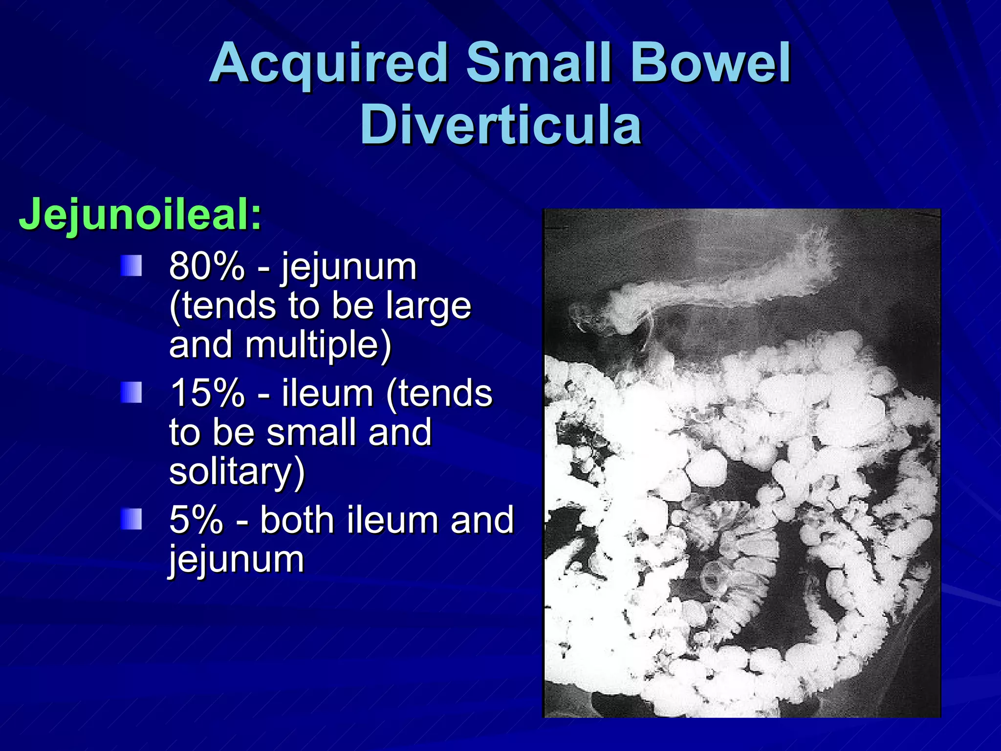 Acquired Small Bowel Diverticula Jejunoileal: 80% - jejunum (tends to be large and multiple) 15% - ileum (tends to be small and solitary) 5% - both ileum and jejunum 