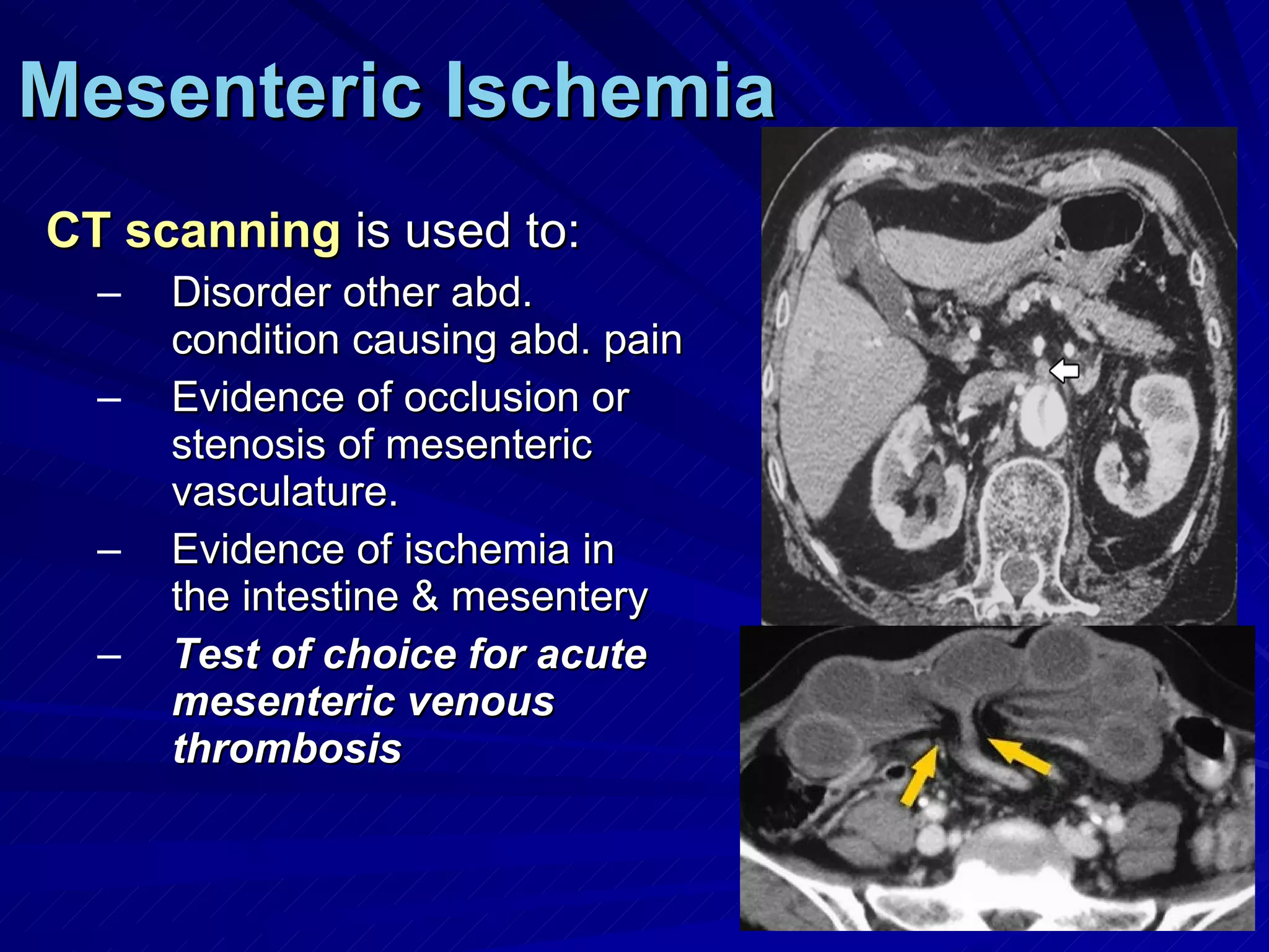 Mesenteric Ischemia CT scanning  is used to: Disorder other abd. condition causing abd. pain Evidence of occlusion or stenosis of mesenteric vasculature. Evidence of ischemia in the intestine & mesentery Test of choice for acute mesenteric venous thrombosis 