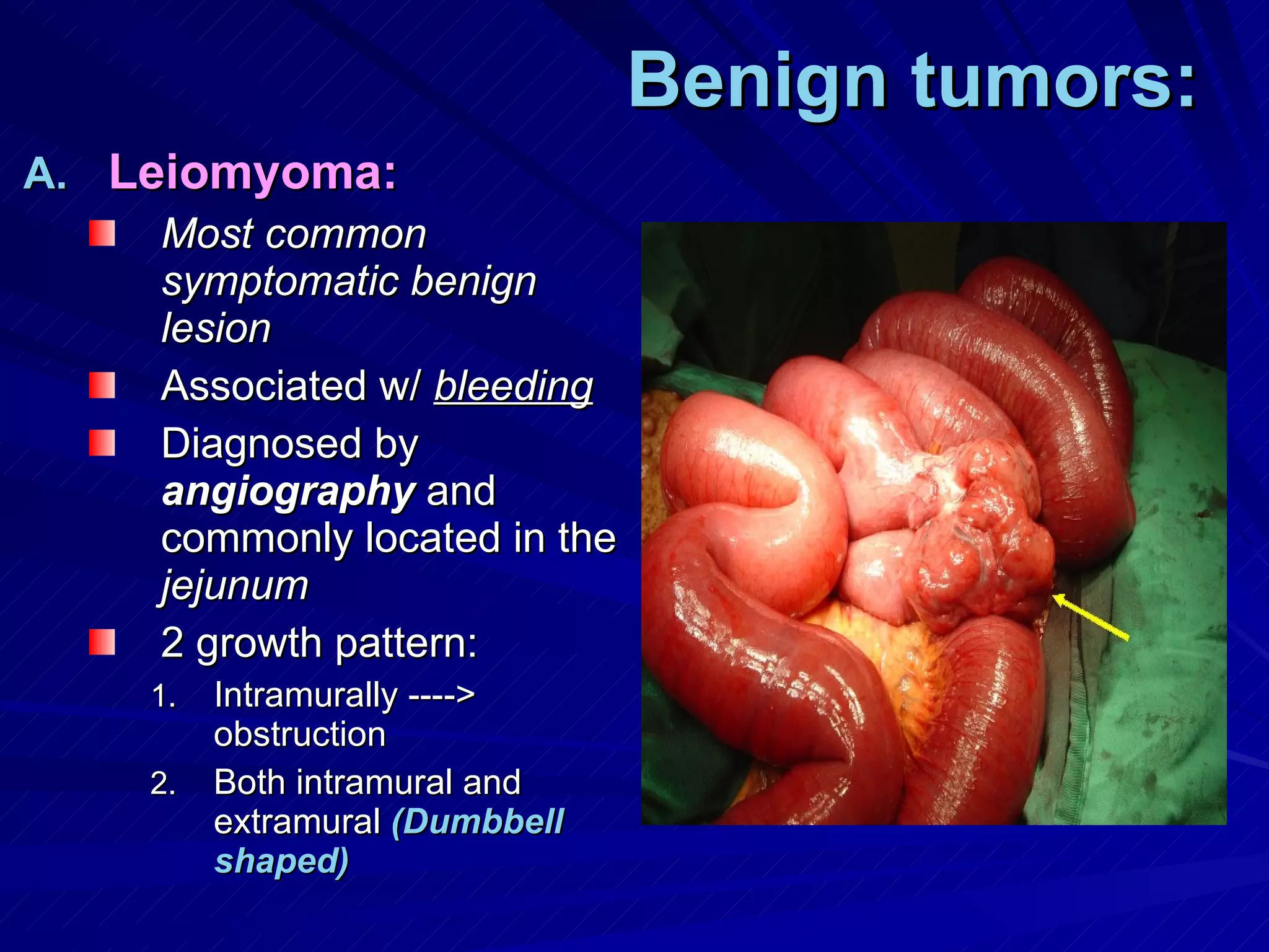 Benign tumors: Leiomyoma: Most common symptomatic benign lesion Associated w/  bleeding Diagnosed by  angiography  and commonly located in the  jejunum 2 growth pattern: Intramurally ----> obstruction Both intramural and extramural  (Dumbbell shaped) 