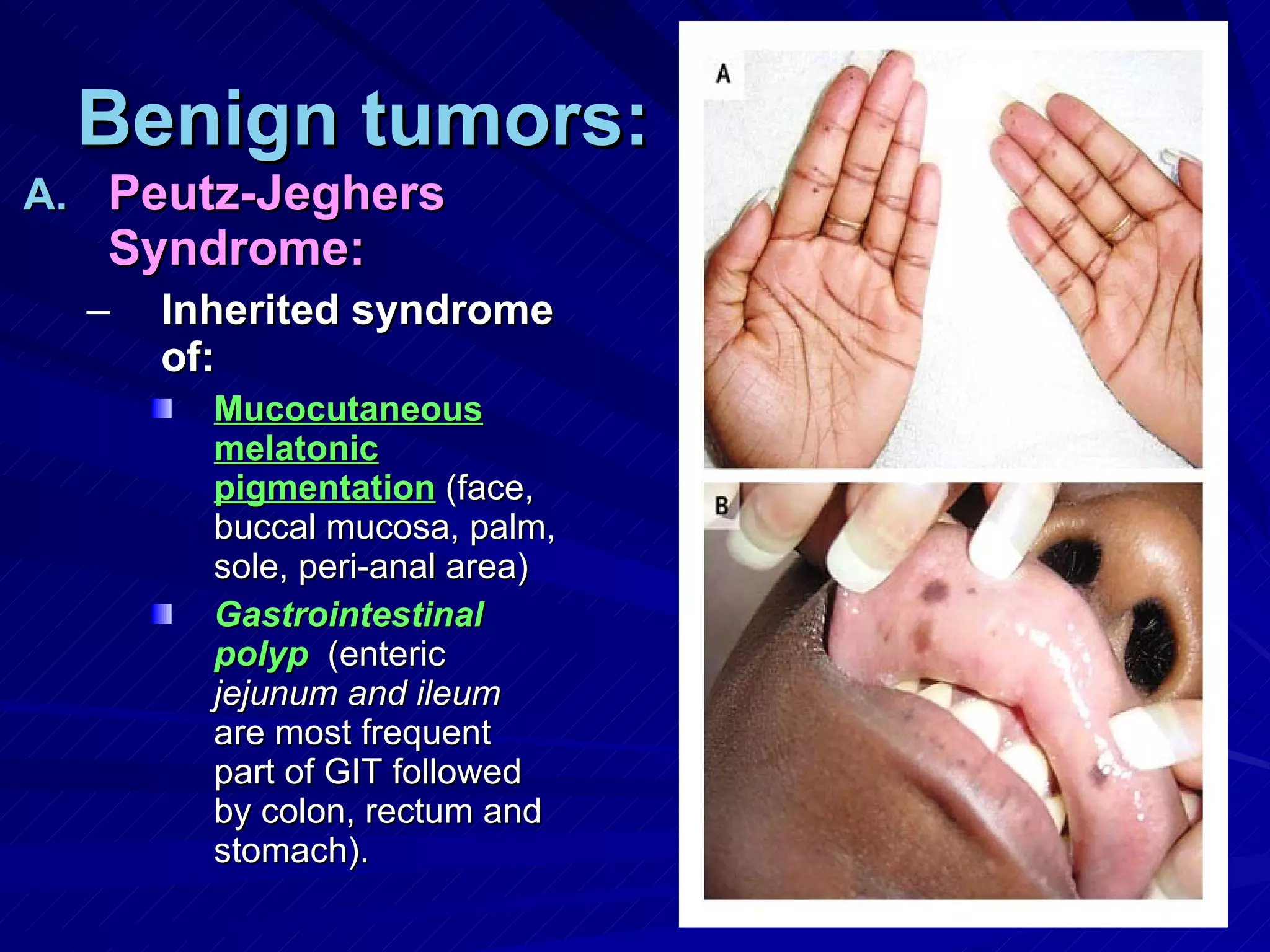 Benign tumors: Peutz-Jeghers Syndrome: Inherited syndrome of: Mucocutaneous melatonic pigmentation  (face, buccal mucosa, palm, sole, peri-anal area) Gastrointestinal polyp   (enteric  jejunum and ileum  are most frequent part of GIT followed by colon, rectum and stomach). 