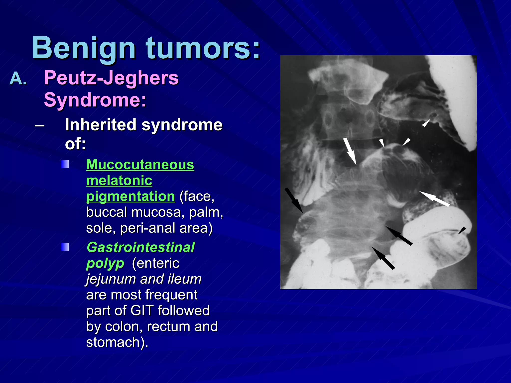 Benign tumors: Peutz-Jeghers Syndrome: Inherited syndrome of: Mucocutaneous melatonic pigmentation  (face, buccal mucosa, palm, sole, peri-anal area) Gastrointestinal polyp   (enteric  jejunum and ileum  are most frequent part of GIT followed by colon, rectum and stomach). 