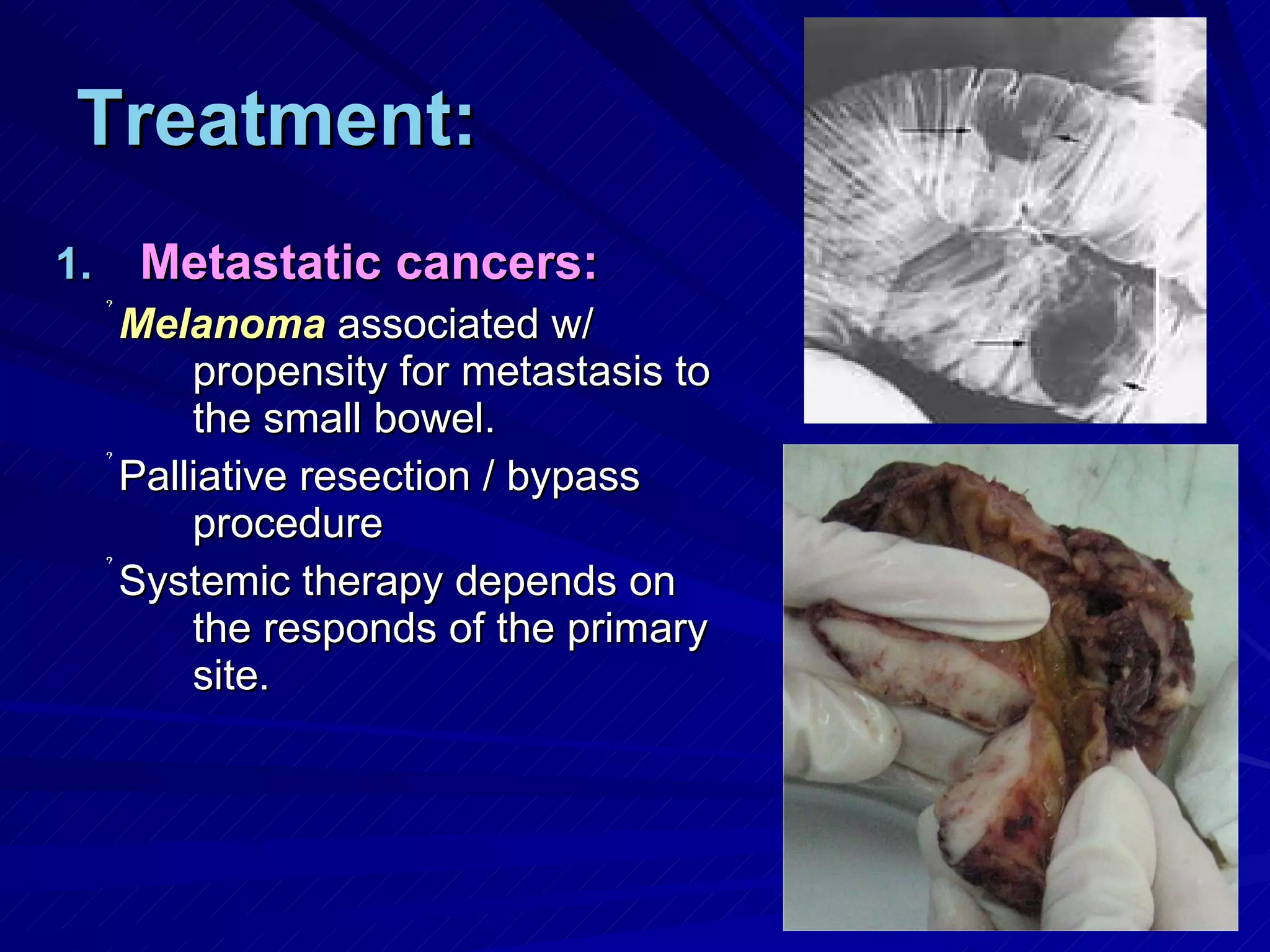 Treatment: Metastatic cancers: Melanoma  associated w/ propensity for metastasis to the small bowel. Palliative resection / bypass procedure Systemic therapy depends on the responds of the primary site. 