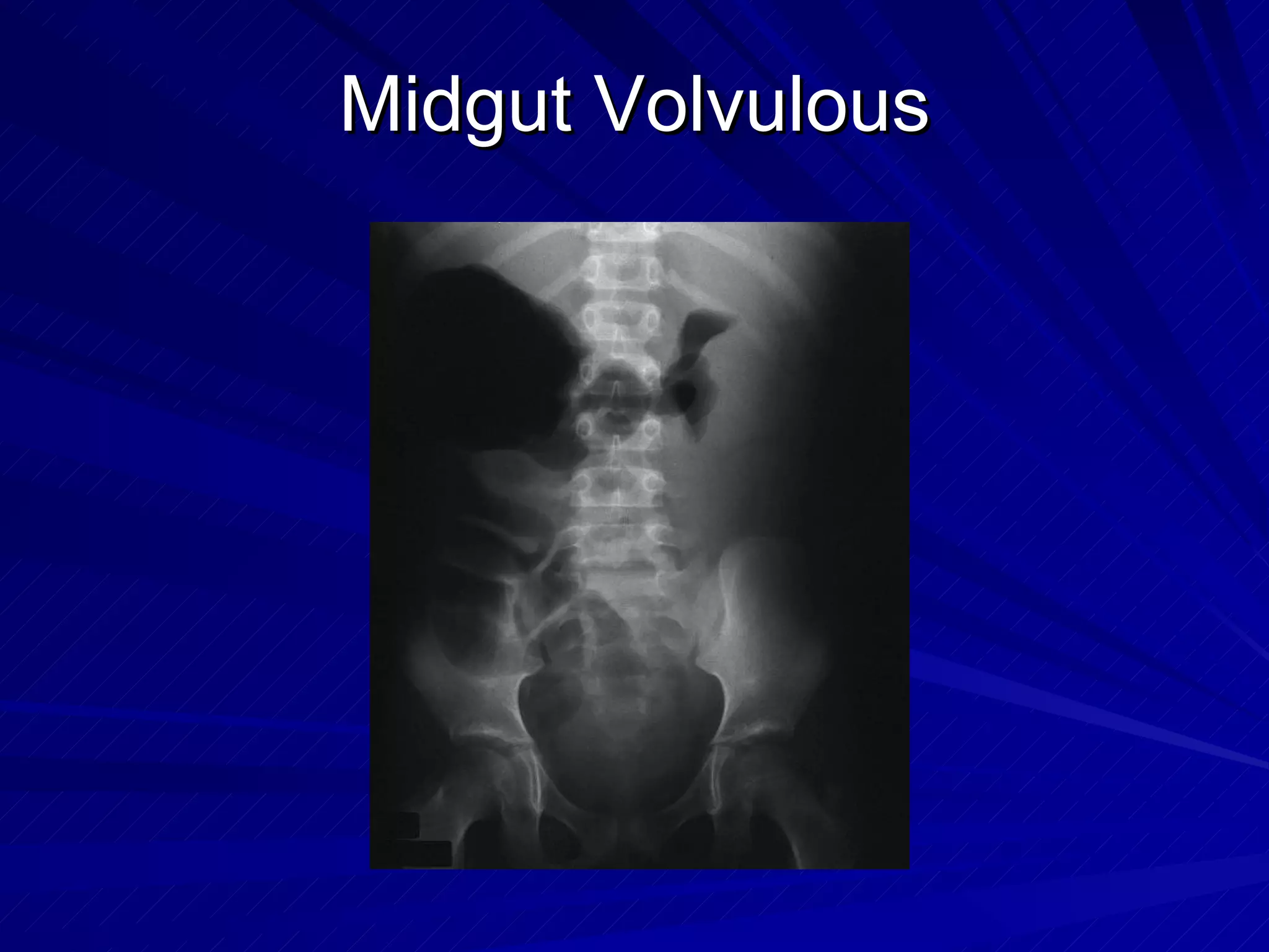 Midgut Volvulous 