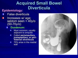 Acquired Small Bowel Diverticula Epidemiology: False diverticula Increases w/ age; seldom seen < 40y/o (50-70y/o) Duodenum:   Most common; usually adjacent to ampulla Called  periampullary, juxtapapillary, or peri-Vaterian diverticula 75% arise in the medial wall 
