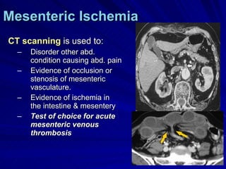 Mesenteric Ischemia CT scanning  is used to: Disorder other abd. condition causing abd. pain Evidence of occlusion or stenosis of mesenteric vasculature. Evidence of ischemia in the intestine & mesentery Test of choice for acute mesenteric venous thrombosis 