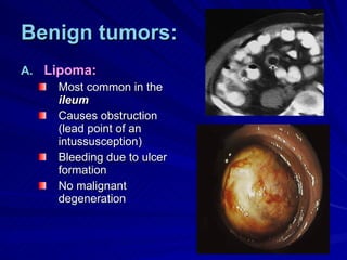 Benign tumors: Lipoma: Most common in the  ileum Causes obstruction (lead point of an intussusception) Bleeding due to ulcer formation No malignant degeneration 