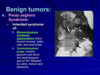 Benign tumors: Peutz-Jeghers Syndrome: Inherited syndrome of: Mucocutaneous melatonic pigmentation  (face, buccal mucosa, palm, sole, peri-anal area) Gastrointestinal polyp   (enteric  jejunum and ileum  are most frequent part of GIT followed by colon, rectum and stomach). 