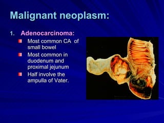 Malignant neoplasm: Adenocarcinoma: Most common CA  of small bowel Most common in duodenum and proximal jejunum Half involve the ampulla of Vater. 