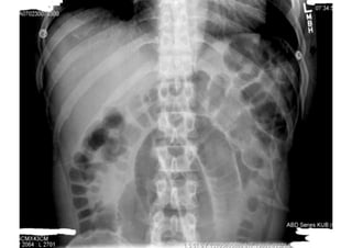 Small Intestine Obstruction. a medical Presentation--11.pdf