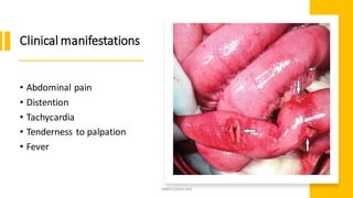 Clinical manifestations
• Abdominal pain
• Distention
• Tachycardia
• Tenderness to palpation
• Fever
SWATILEKHA DAS
 