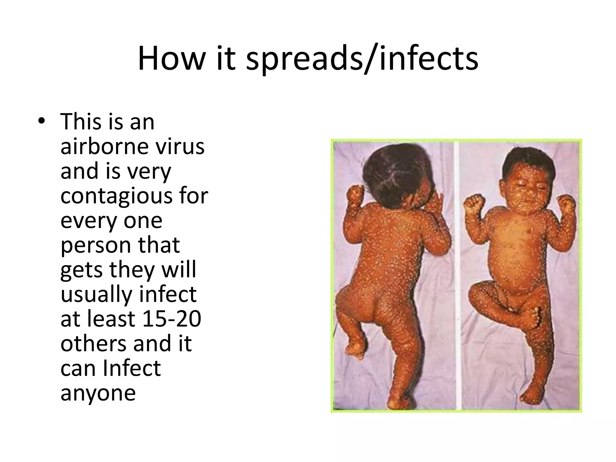 Smallpox | PPTX