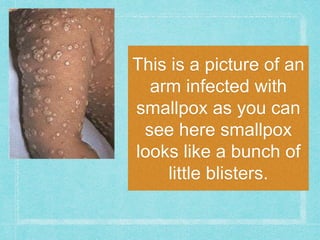 This is a picture of an
arm infected with
smallpox as you can
see here smallpox
looks like a bunch of
little blisters.
 