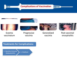 Complications of Vaccination
Treatments for Complications:
1. Vaccinia Immune
Globulin(VIG)
2. Cidofovir
Eczema
vaccinatum
Progressive
vaccinia
Generalized
vaccinia
Post-vaccinial
encephalitis
 
