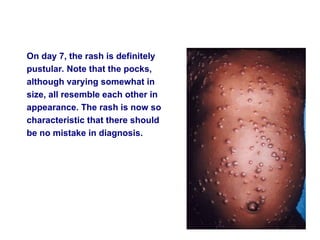 Pustular Rash Smallpox Smallpox ppt for nursing Students GNM & B.Sc