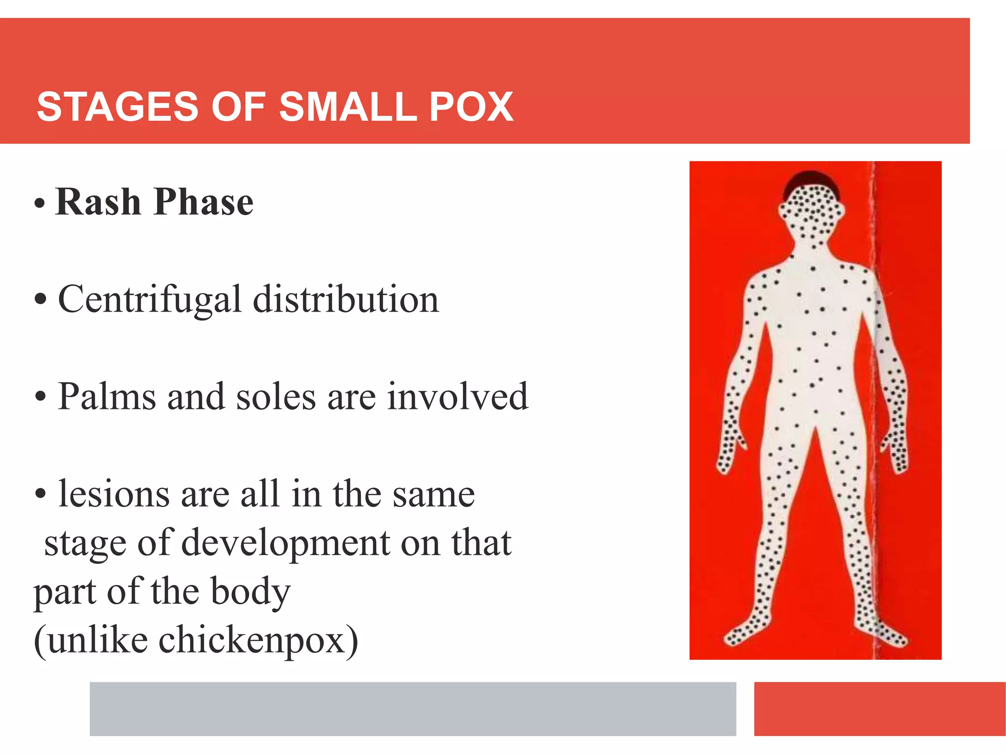 STAGES OF SMALL POX
• Rash Phase
• Centrifugal distribution
• Palms and soles are involved
• lesions are all in the same
stage of development on that
part of the body
(unlike chickenpox)
 