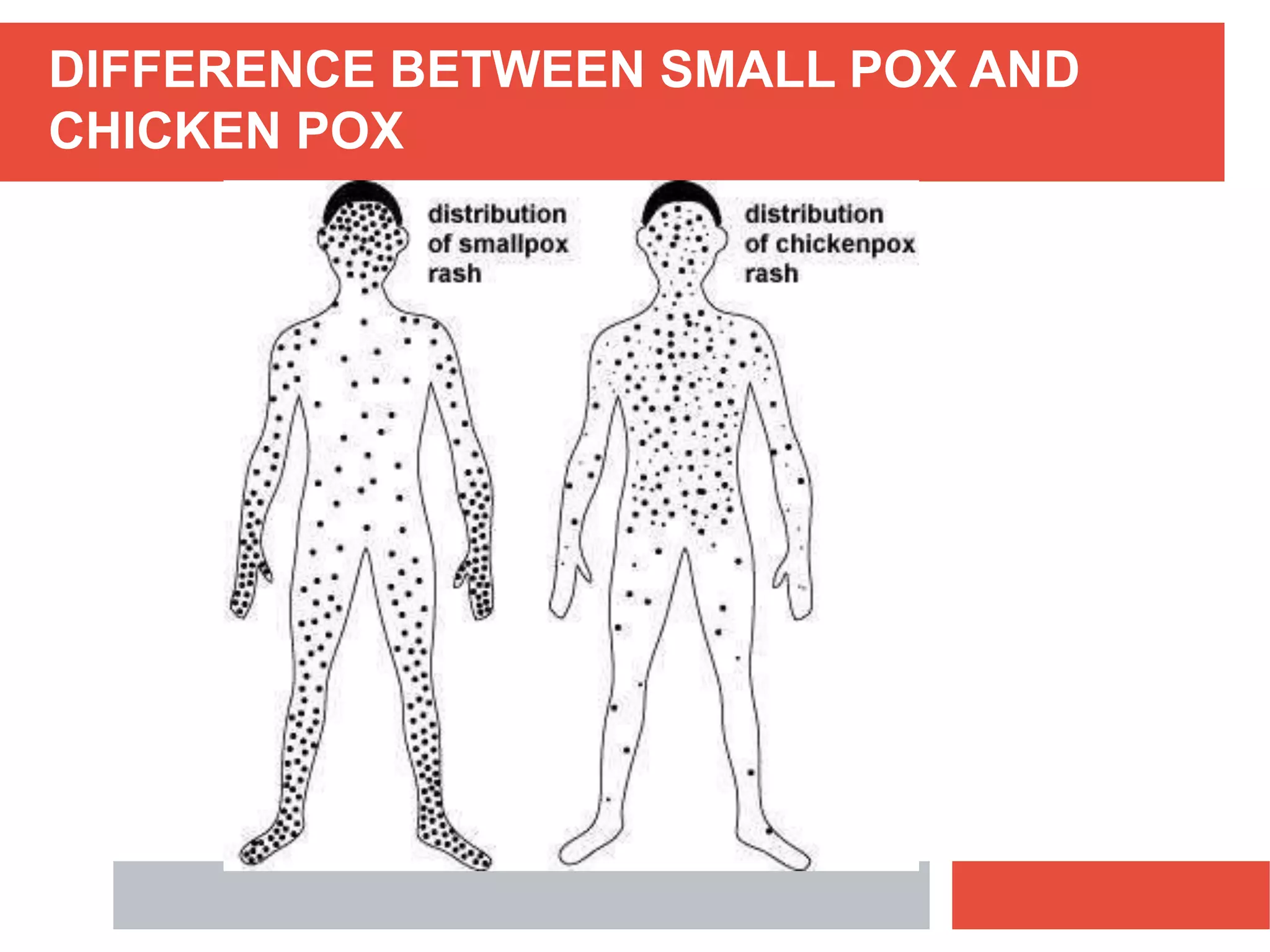 DIFFERENCE BETWEEN SMALL POX AND
CHICKEN POX
 