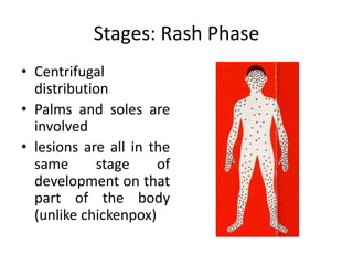 Stages: Rash Phase
• Centrifugal
distribution
• Palms and soles are
involved
• lesions are all in the
same stage of
development on that
part of the body
(unlike chickenpox)
 