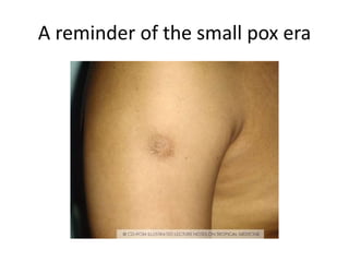 A reminder of the small pox era
 