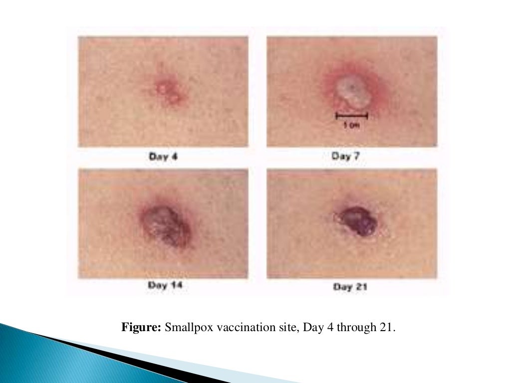 Smallpox skin contact - jopoeng