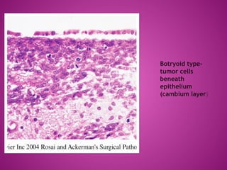 SMALL ROUND CELL TUMOR -1 powerpoint.ppt