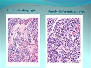Differentiating type
Poorly differentiated type
 