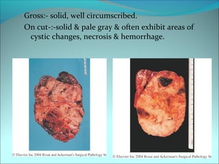 Gross:- solid, well circumscribed.
On cut-:-solid & pale gray & often exhibit areas of
cystic changes, necrosis & hemorrhage.
 