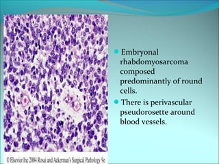 Embryonal
rhabdomyosarcoma
composed
predominantly of round
cells.
There is perivascular
pseudorosette around
blood vessels.
 