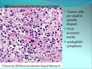 Microscopically(Embryonal type)
Tumor cells
are small &
spindle
shaped.
Oval
eccentric
nuclei
acidophilic
cytoplasm.
 