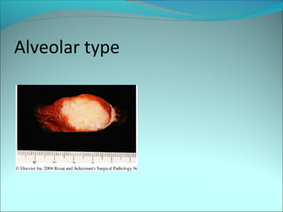Alveolar type
 