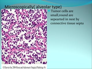 Microscopically( alveolar type)
Tumor cells are
small,round are
sepearted in nest by
connective tissue septa
 