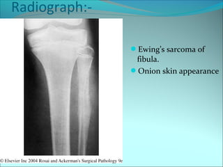 Radiograph:-
Ewing’s sarcoma of
fibula.
Onion skin appearance
 