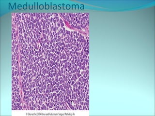 Medulloblastoma
 