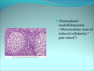 Desmoplastic
medulloblastoma
:-Micronodular zone of
reduced cellularity( “
pale island”)
 