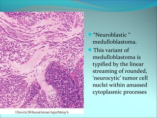 “Neuroblastic “
medulloblastoma.
This variant of
medulloblastoma is
typified by the linear
streaming of rounded,
‘neurocytic’ tumor cell
nuclei within amassed
cytoplasmic processes
 