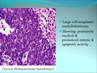 Large cell/anaplastic
medulloblastoma.
Showing prominent
nucleoli &
pronunced mitotic &
apoptotic activity .
 