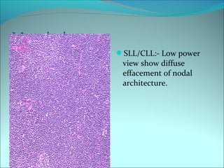 Morphology:-
SLL/CLL:- Low power
view show diffuse
effacement of nodal
architecture.
 