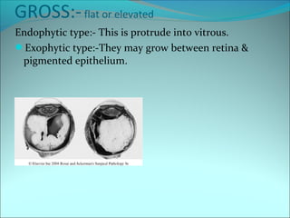 GROSS:-flat or elevated
Endophytic type:- This is protrude into vitrous.
Exophytic type:-They may grow between retina &
pigmented epithelium.
 