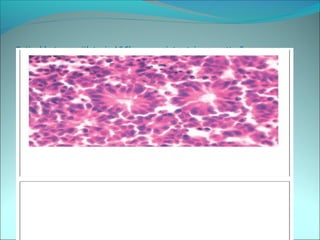 Retinoblastoma with typical “ Flexner – wintersteiner rosettes”.
 