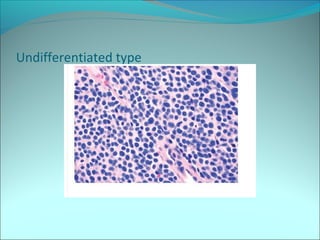 Undifferentiated type
 